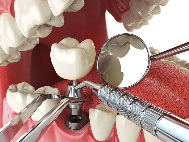Best Knocked-Out Tooth (Avulsed Tooth) Treatment in Rupert, WV
